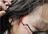 Ů��˿Ϊ��ż��ͷ��Ѫ��(������317)